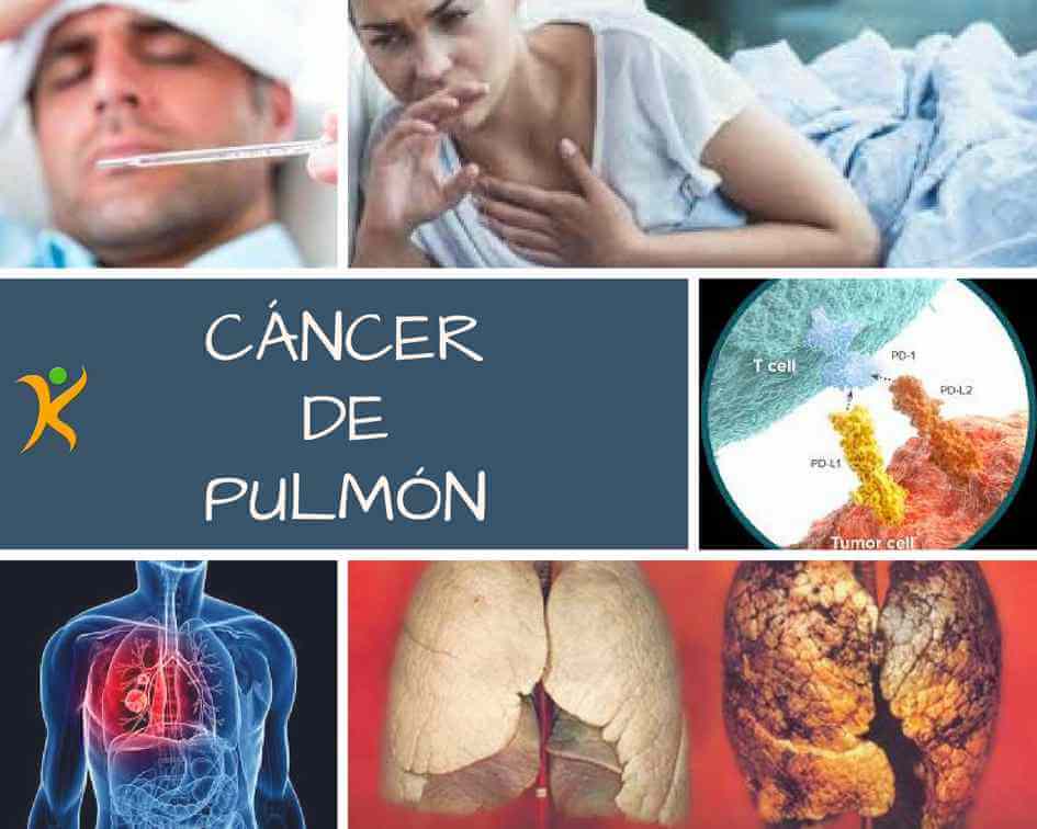 cancer de pulmon